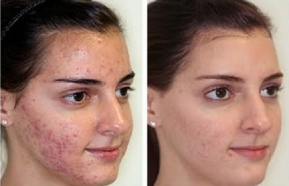 Ossigenoterapia Viso Prima e Dopo per acne